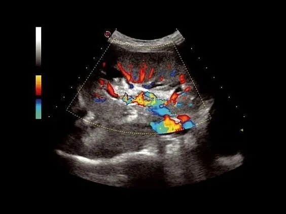 Клинические изображения УЗИ аппарат Esaote MyLab Seven