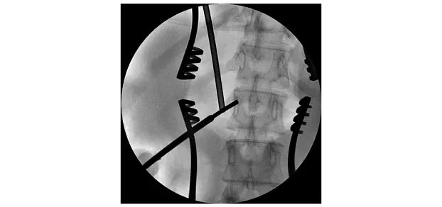 Клинические изображения Philips BV Vectra С-дуга