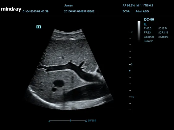 Клинические изображения УЗИ аппарат Mindray DC-60 X-Insight