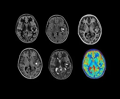 Клинические изображения МРТ аппарат GE SIGNA Voyager 1.5T