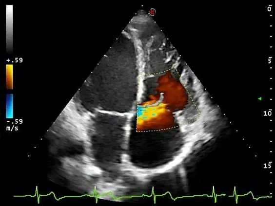 Клинические изображения УЗИ аппарат Esaote MyLab Eight