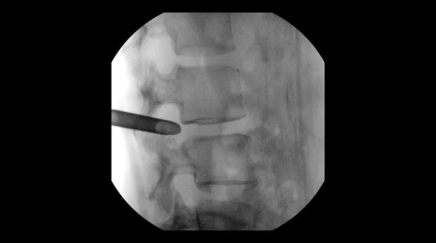 Поясничный отдел позвоночника, боковая проекция, 21 см