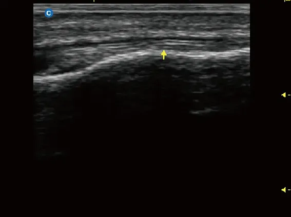 Клинические изображения Chison SonoTouch 30 портативный УЗИ аппарат