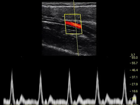 Клинические изображения Chison SonoTouch 30 портативный УЗИ аппарат