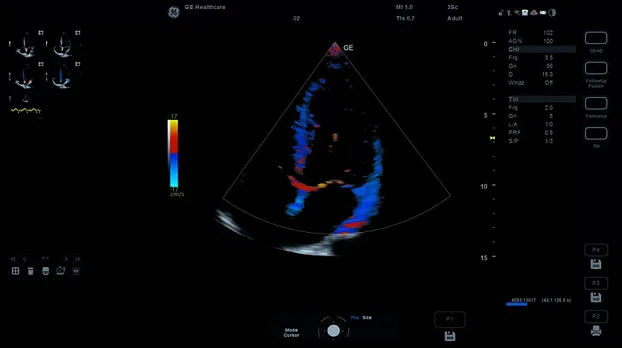 Versana Essential GE Healthcare