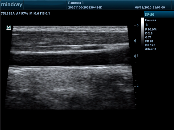 Mindray DP-50 Color портативный аппарат УЗИ 